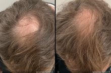 Load image into Gallery viewer, Ariessence pure PDGF+ treatment.

